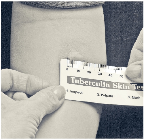 FIGURE 1. The tuberculin skin test result in this picture should be recorded as 16 mm. The '0' mm ruler line is inside the edge of the left dot.